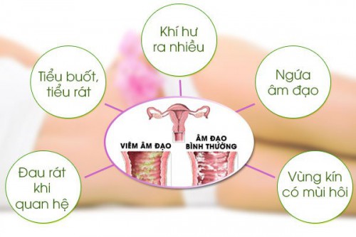 Viêm nhiễm phụ khoa. Dấu hiệu nhận biết, nguyên nhân và cách phòng tránh viên nhiễm phụ khoa.